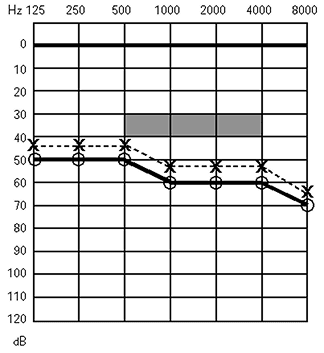 Baisse auditive de perception